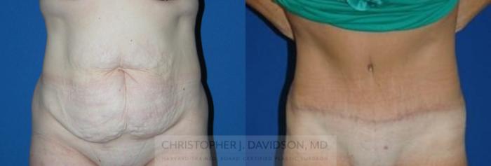 Lower Body Lift Case 106 Before & After View #1 | Boston, MA | Christopher J. Davidson, MD