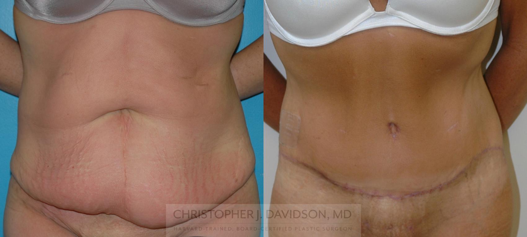 Lower Body Lift Case 116 Before & After View #1 | Boston, MA | Christopher J. Davidson, MD