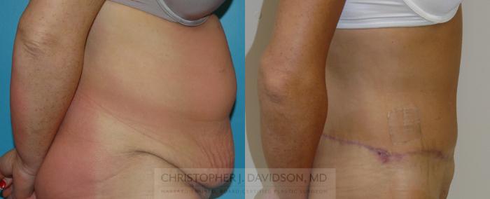 Lower Body Lift Case 116 Before & After View #2 | Boston, MA | Christopher J. Davidson, MD
