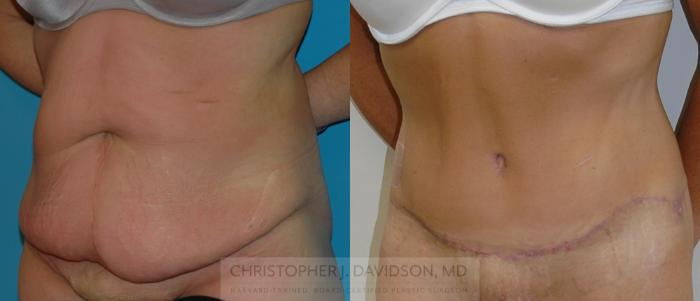Lower Body Lift Case 116 Before & After View #4 | Boston, MA | Christopher J. Davidson, MD