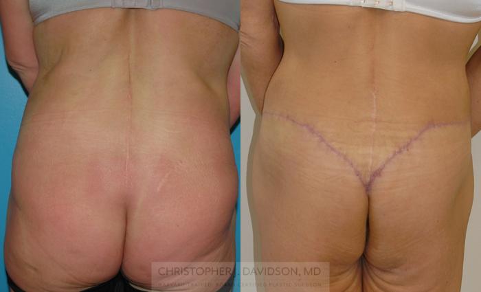 Lower Body Lift Case 116 Before & After View #5 | Boston, MA | Christopher J. Davidson, MD