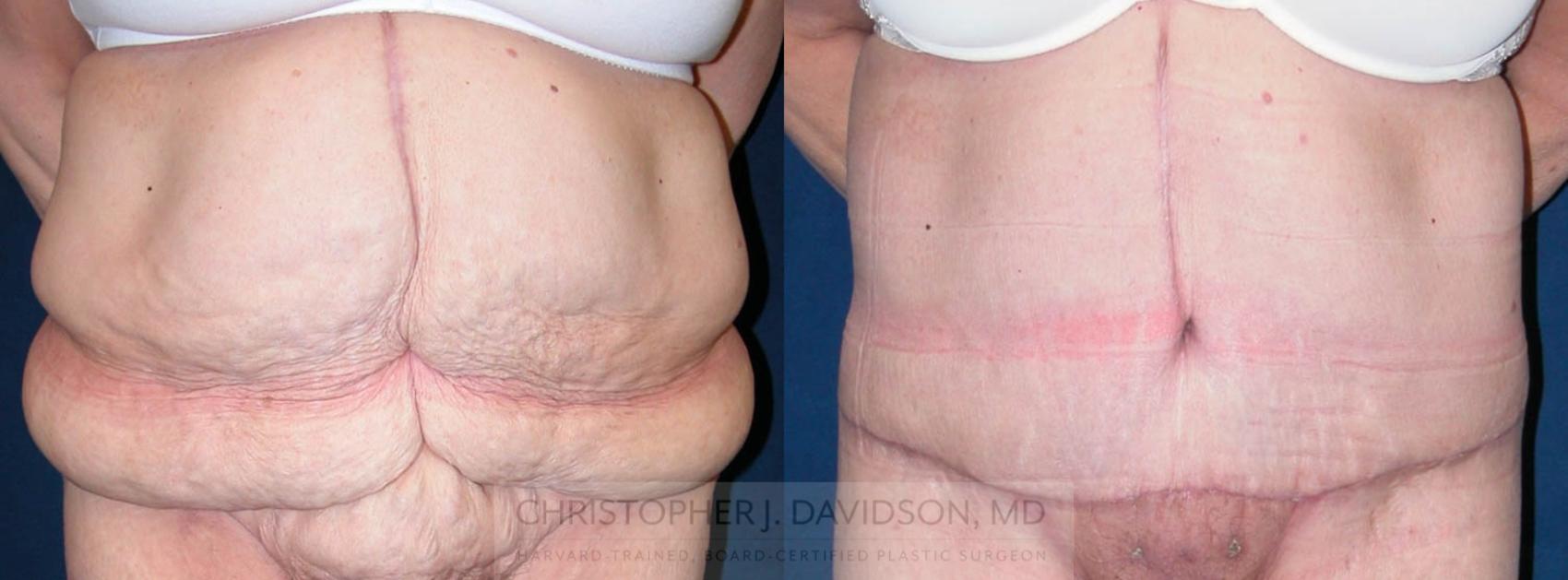 Lower Body Lift Case 120 Before & After View #1 | Boston, MA | Christopher J. Davidson, MD