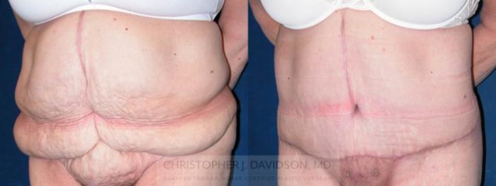 Lower Body Lift Case 120 Before & After View #2 | Boston, MA | Christopher J. Davidson, MD