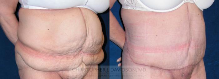 Lower Body Lift Case 120 Before & After View #3 | Boston, MA | Christopher J. Davidson, MD