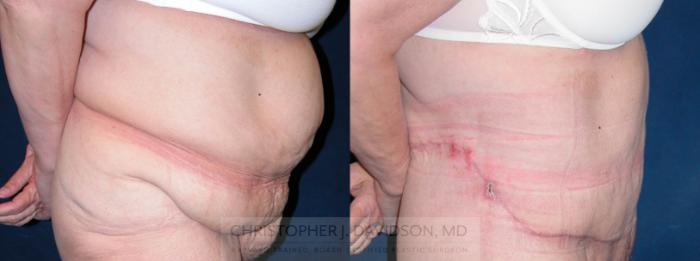 Lower Body Lift Case 120 Before & After View #4 | Boston, MA | Christopher J. Davidson, MD