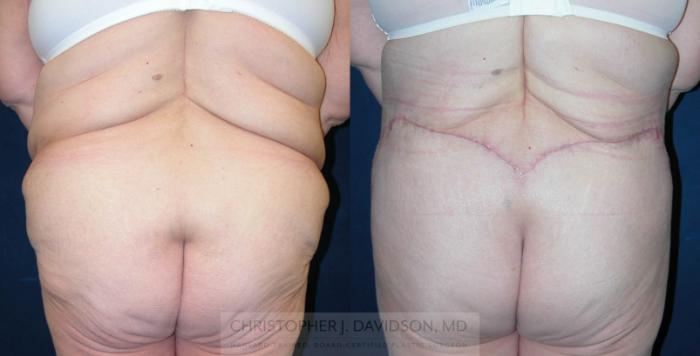 Lower Body Lift Case 120 Before & After View #5 | Boston, MA | Christopher J. Davidson, MD