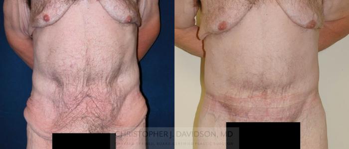 Lower Body Lift Case 124 Before & After View #1 | Boston, MA | Christopher J. Davidson, MD