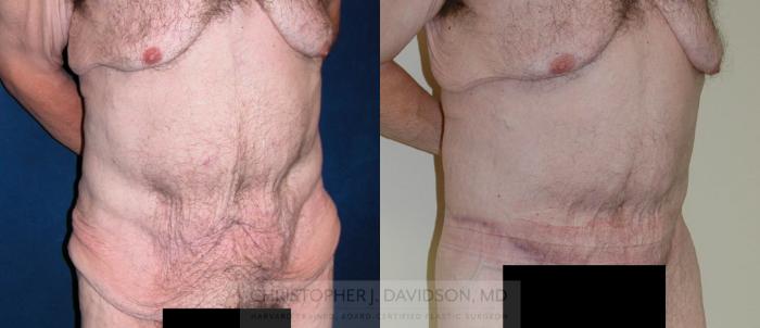 Lower Body Lift Case 124 Before & After View #2 | Boston, MA | Christopher J. Davidson, MD