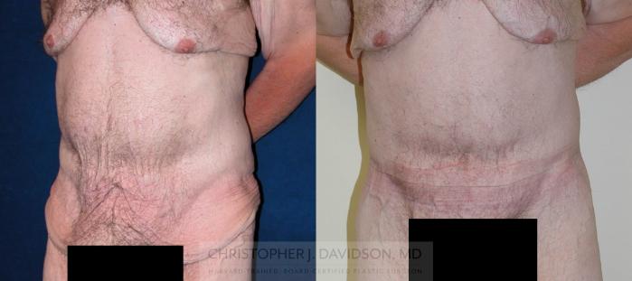 Lower Body Lift Case 124 Before & After View #3 | Boston, MA | Christopher J. Davidson, MD