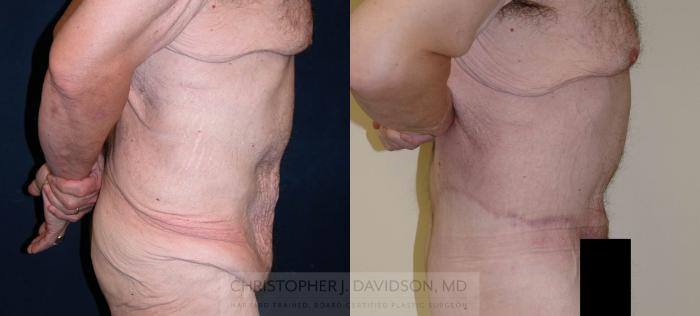 Lower Body Lift Case 124 Before & After View #4 | Boston, MA | Christopher J. Davidson, MD