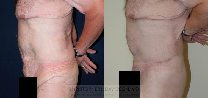 Lower Body Lift Case 124 Before & After View #5 | Boston, MA | Christopher J. Davidson, MD