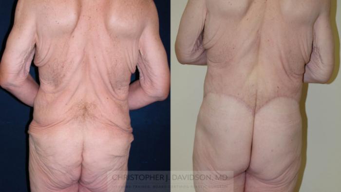 Lower Body Lift Case 124 Before & After View #6 | Boston, MA | Christopher J. Davidson, MD