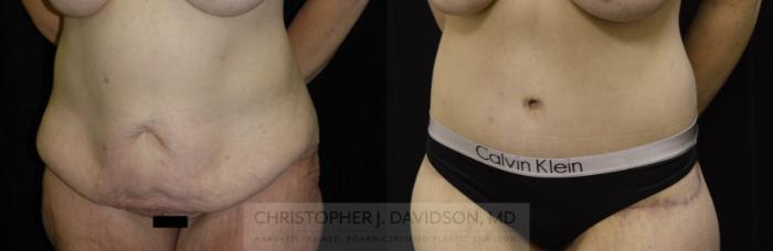 Lower Body Lift Case 134 Before & After Left Oblique | Boston, MA | Christopher J. Davidson, MD