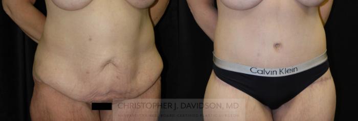 Lower Body Lift Case 134 Before & After Right Oblique | Boston, MA | Christopher J. Davidson, MD