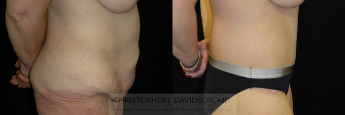 Lower Body Lift Case 134 Before & After Right Side | Boston, MA | Christopher J. Davidson, MD