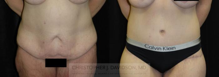 Lower Body Lift Case 134 Before & After View #1 | Boston, MA | Christopher J. Davidson, MD