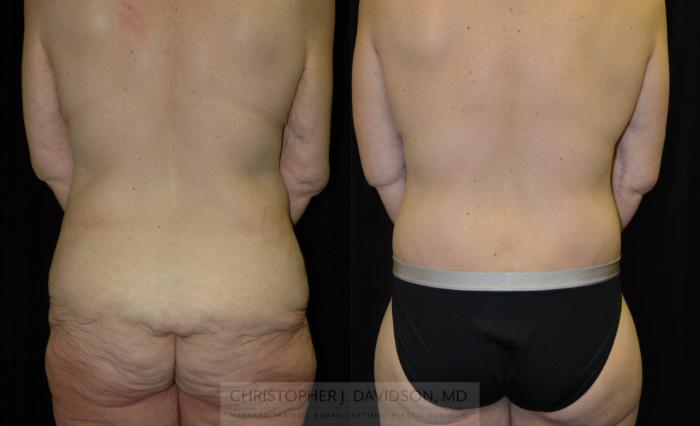 Lower Body Lift Case 134 Before & After View #4 | Boston, MA | Christopher J. Davidson, MD
