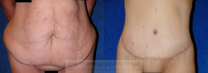 Lower Body Lift Case 138 Before & After View #1 | Boston, MA | Christopher J. Davidson, MD