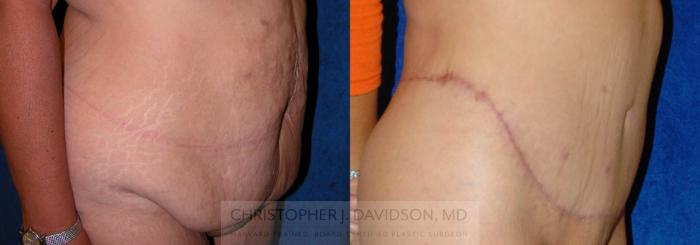 Lower Body Lift Case 138 Before & After View #2 | Boston, MA | Christopher J. Davidson, MD