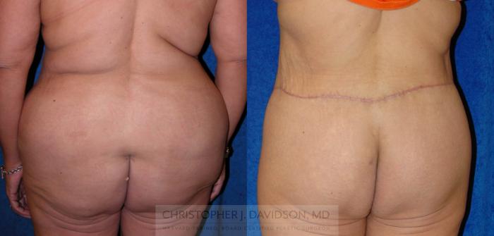 Lower Body Lift Case 138 Before & After View #3 | Boston, MA | Christopher J. Davidson, MD