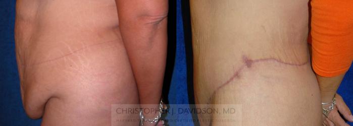 Lower Body Lift Case 138 Before & After View #4 | Boston, MA | Christopher J. Davidson, MD