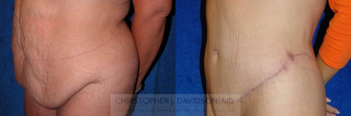 Lower Body Lift Case 138 Before & After View #5 | Boston, MA | Christopher J. Davidson, MD