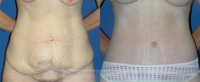 Lower Body Lift Case 149 Before & After View #1 | Boston, MA | Christopher J. Davidson, MD
