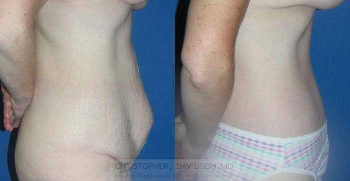 Lower Body Lift Case 149 Before & After View #2 | Boston, MA | Christopher J. Davidson, MD