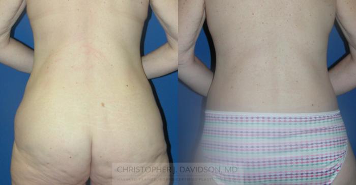 Lower Body Lift Case 149 Before & After View #3 | Boston, MA | Christopher J. Davidson, MD
