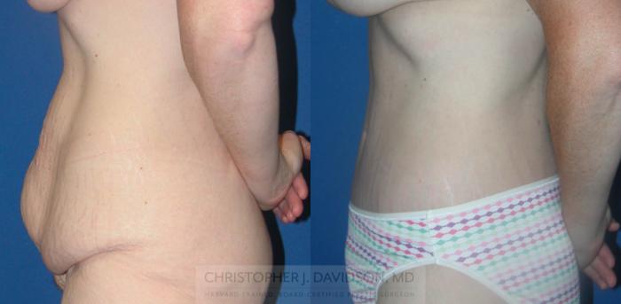 Lower Body Lift Case 149 Before & After View #4 | Boston, MA | Christopher J. Davidson, MD