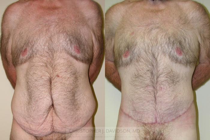 Lower Body Lift Case 156 Before & After View #1 | Boston, MA | Christopher J. Davidson, MD