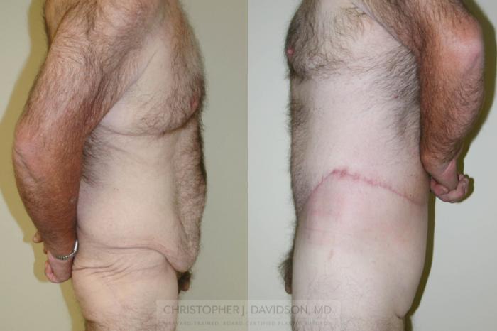 Lower Body Lift Case 156 Before & After View #2 | Boston, MA | Christopher J. Davidson, MD