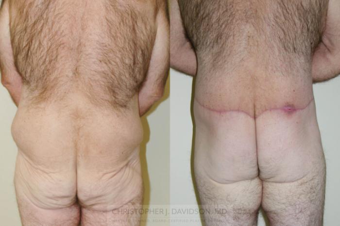 Lower Body Lift Case 156 Before & After View #3 | Boston, MA | Christopher J. Davidson, MD