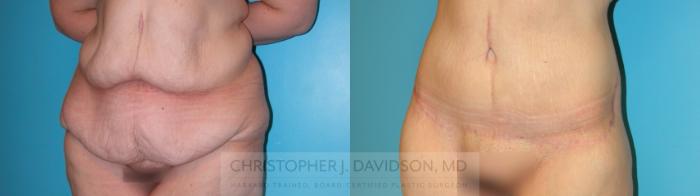 Lower Body Lift Case 160 Before & After Left Oblique | Boston, MA | Christopher J. Davidson, MD