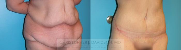 Lower Body Lift Case 160 Before & After Right Oblique | Boston, MA | Christopher J. Davidson, MD