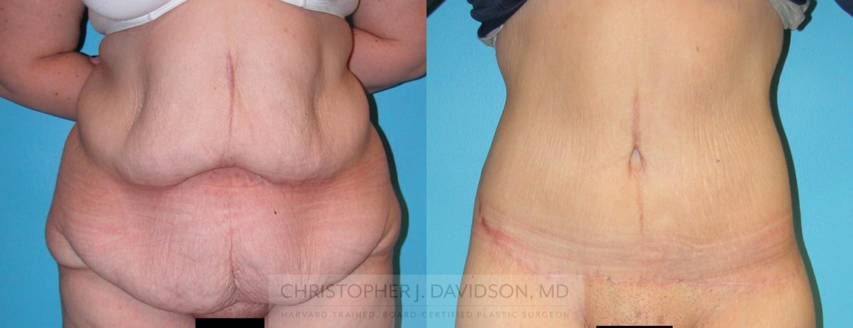 Lower Body Lift Case 160 Before & After View #1 | Boston, MA | Christopher J. Davidson, MD