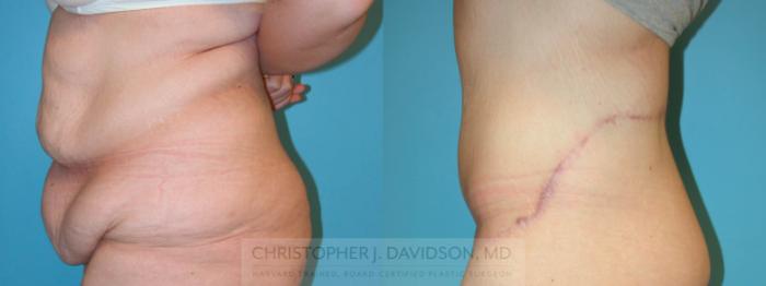 Lower Body Lift Case 160 Before & After View #2 | Boston, MA | Christopher J. Davidson, MD