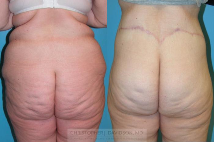 Lower Body Lift Case 160 Before & After View #3 | Boston, MA | Christopher J. Davidson, MD