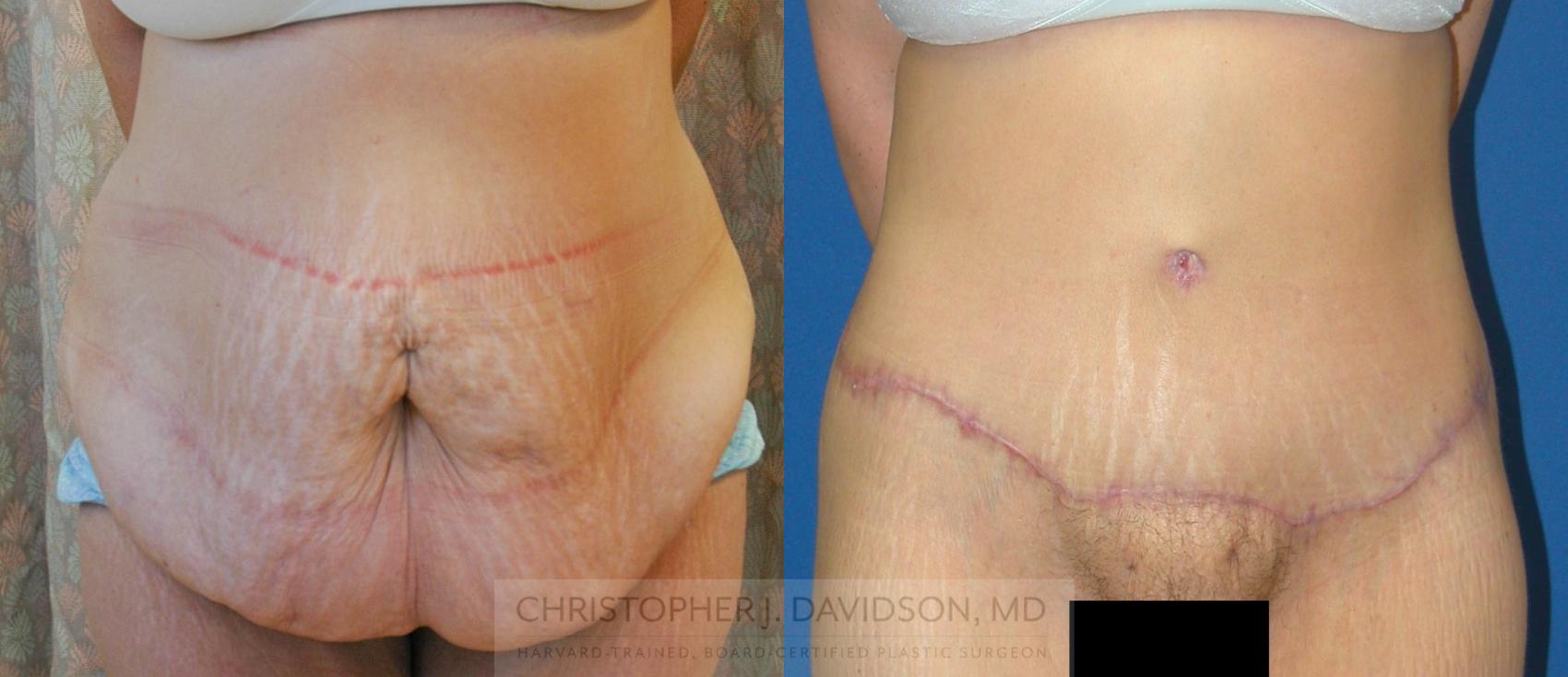 Lower Body Lift Case 162 Before & After View #1 | Wellesley, MA | Christopher J. Davidson, MD