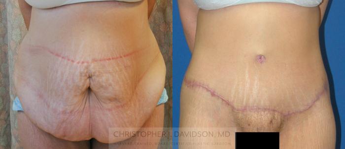 Lower Body Lift Case 162 Before & After View #1 | Boston, MA | Christopher J. Davidson, MD