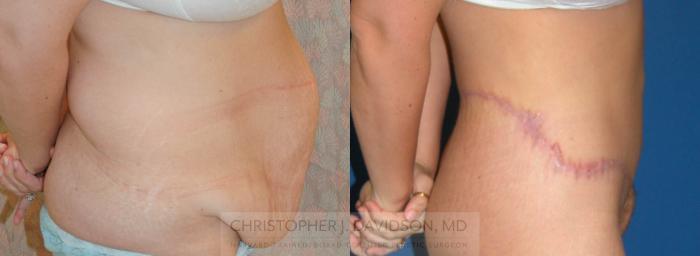 Lower Body Lift Case 162 Before & After View #2 | Boston, MA | Christopher J. Davidson, MD