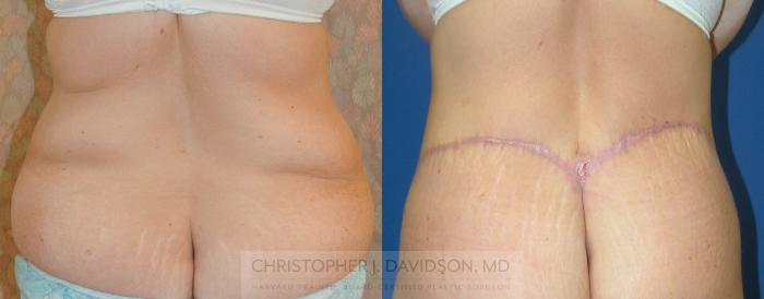 Lower Body Lift Case 162 Before & After View #3 | Boston, MA | Christopher J. Davidson, MD