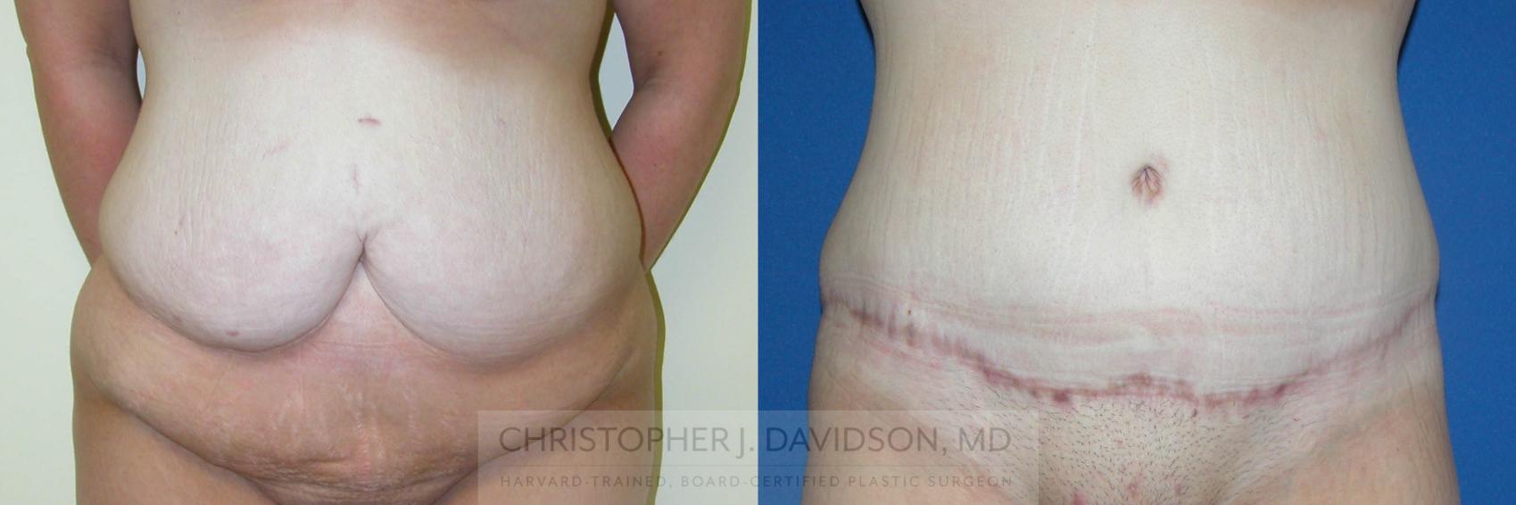 Lower Body Lift Case 170 Before & After View #1 | Wellesley, MA | Christopher J. Davidson, MD