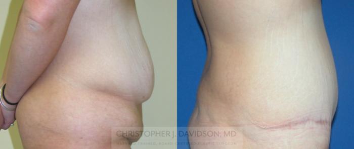 Lower Body Lift Case 170 Before & After View #2 | Boston, MA | Christopher J. Davidson, MD