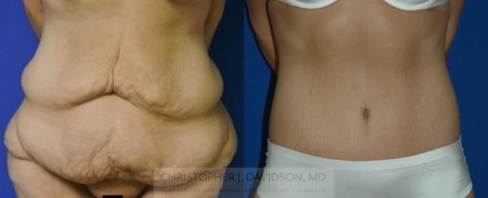 Lower Body Lift Case 176 Before & After View #1 | Boston, MA | Christopher J. Davidson, MD