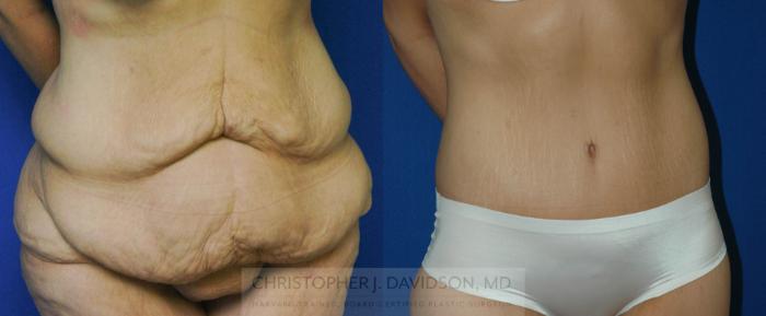 Lower Body Lift Case 176 Before & After View #2 | Boston, MA | Christopher J. Davidson, MD