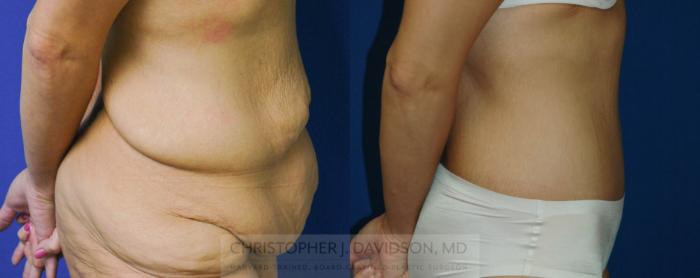 Lower Body Lift Case 176 Before & After View #3 | Boston, MA | Christopher J. Davidson, MD