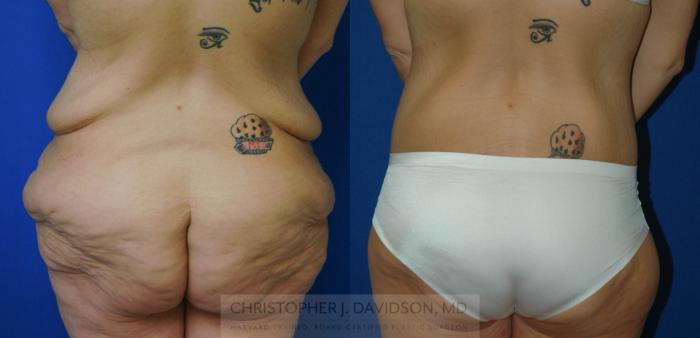 Lower Body Lift Case 176 Before & After View #4 | Boston, MA | Christopher J. Davidson, MD