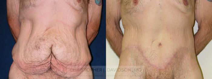 Lower Body Lift Case 177 Before & After View #1 | Boston, MA | Christopher J. Davidson, MD