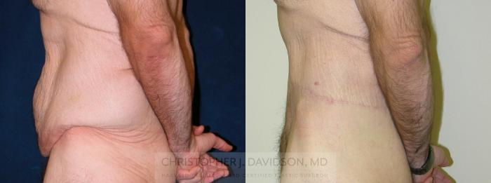 Lower Body Lift Case 177 Before & After View #2 | Boston, MA | Christopher J. Davidson, MD
